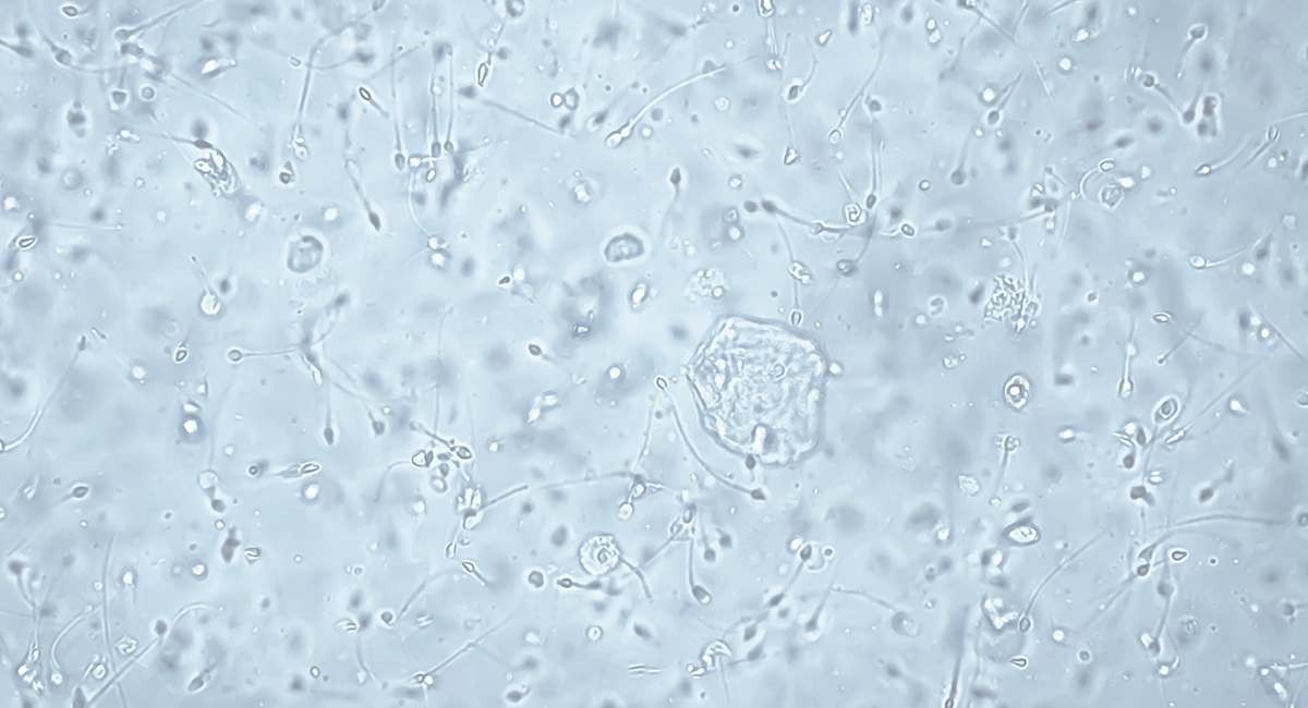 l carnitina espermograma Pacientes do sexo masculino que desejam melhorar a fertilidade devem, primeiramente, passar por uma avaliao clnica completa. Isso inclui a realizao de um para anlise da qualidade Complemento alimenticio para la Fertilidad